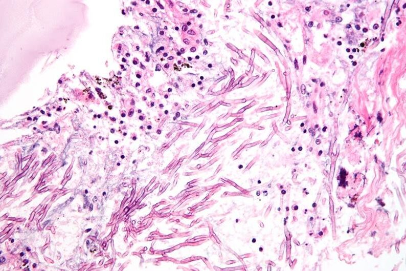 Les champignons perturbent le système immunitaire et entraînent la formation de mycoses