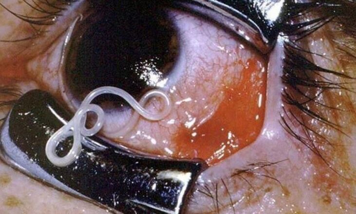 parasite dans les yeux humains